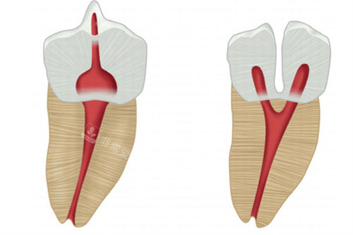 畸形舌侧窝卡通图