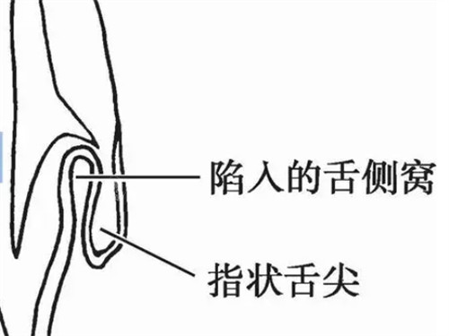 畸形舌侧窝放大看的样子