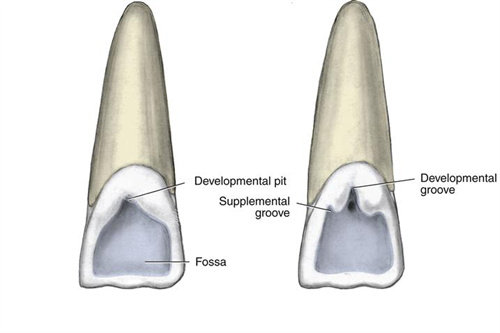 正常舌侧窝和畸形舌侧窝