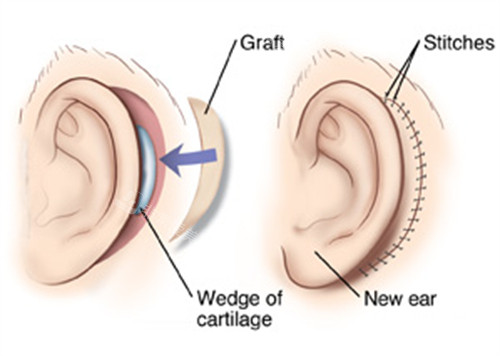 耳再造手术的切口 耳再造手术的切口