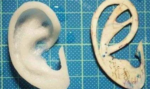 Medpor人工支架耳再造手术 Medpor人工支架耳再造手术