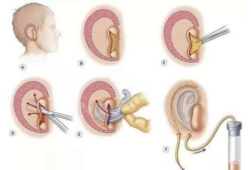 赴韩做耳再造手术的真实经历分享，术前3D设计精细/小创口技术改善快/耳朵形态自然真实超满意！