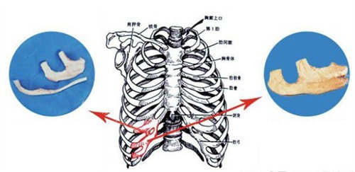 耳再造手术自体肋软骨 耳再造手术自体肋软骨