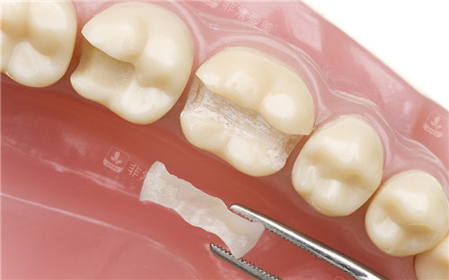 嵌体补牙