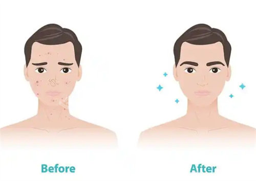 祛痘前后对比 祛痘前后对比