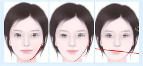 面部不对称的类型