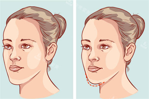 正常脸型和反颌脸型对比 正常脸型和反颌脸型对比
