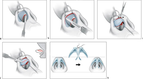鼻头缩小手术过程图