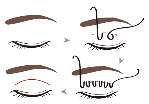 埋线双眼皮手术过程 埋线双眼皮手术过程