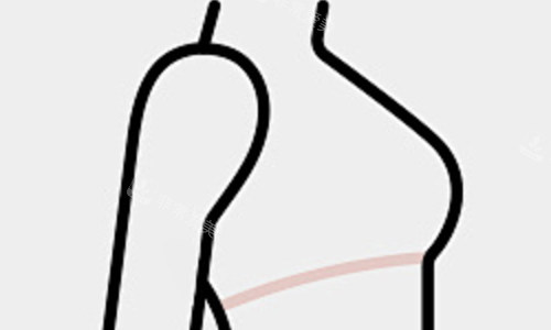 隆胸后展示 隆胸后展示