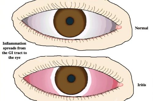 虹膜炎与健康眼睛对比