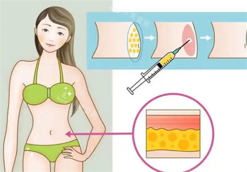 吸脂手术腰部 吸脂手术腰部