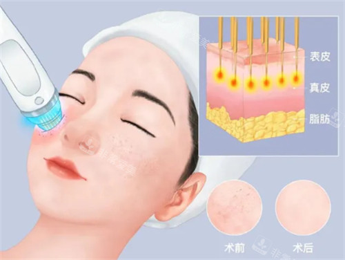 在韩做了皮肤管理，小气泡+黄金微针+胶原水光全安排，皮肤透亮无改善期，体验感直接拉满