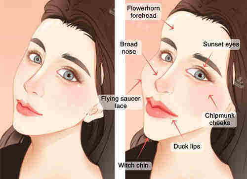 女性面部填充 女性面部填充