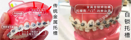 牙齿矫正牙套对比实物展示图 牙齿矫正牙套对比实物展示图