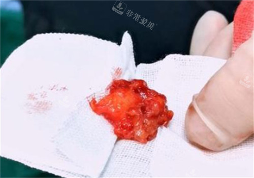 下巴取出的生长因子