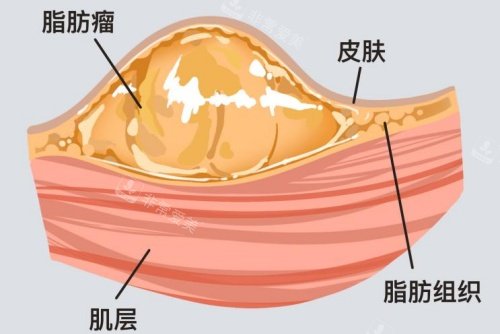脂肪瘤所在皮肤层面示意图