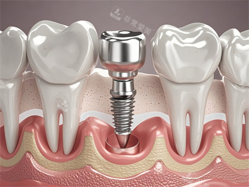 种植牙模型图片展示