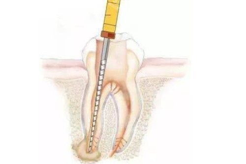 根管治疗卡通展示图