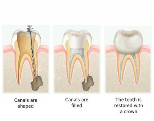 根管治疗手术步骤