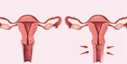 3D生物束带紧缩术对比图 3D生物束带紧缩术对比图