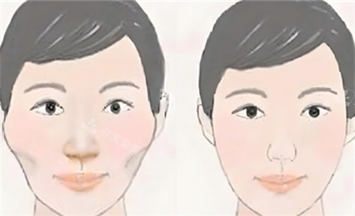 顴骨內(nèi)推術(shù)前后對比動畫圖