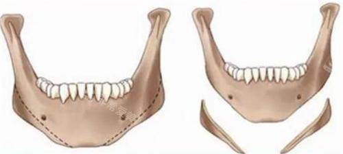 下頜角削骨前后對比