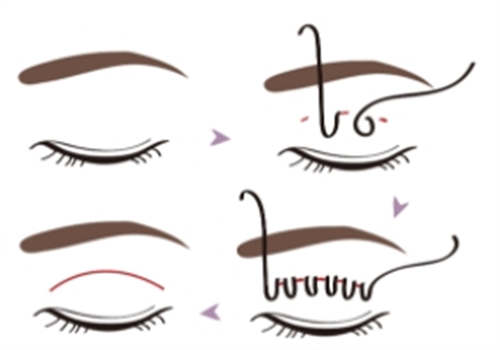 韩国达尔比整形外科怎么样?想去这家做轮廓、鼻子手术，还想抗衰拉皮?听听真实评价！