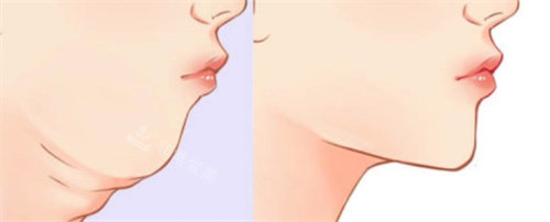 韩国做下巴肌肉捆绑哪家医院好？分享韩国本都韩女推荐的整形医院名单！