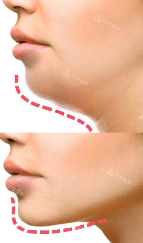 双下巴抽脂前后对比侧面图 双下巴抽脂前后对比侧面图