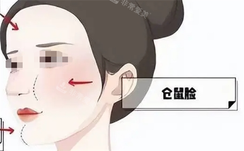 玻尿酸后馒化现象动画展示 玻尿酸后馒化现象动画展示