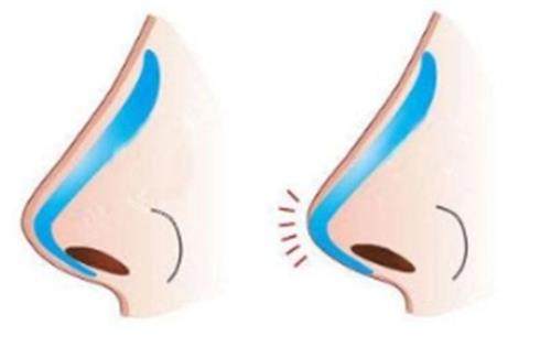 惠州隆鼻便宜医院大揭秘！天成/华康/鹏爱/时光四家实力对比