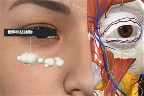 异物注射取出技巧