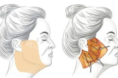 韩国釜山丽婷整形外科...