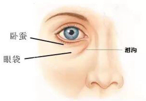 眼下卧蚕泪沟及眼袋对比示意图 眼下卧蚕泪沟及眼袋对比示意图