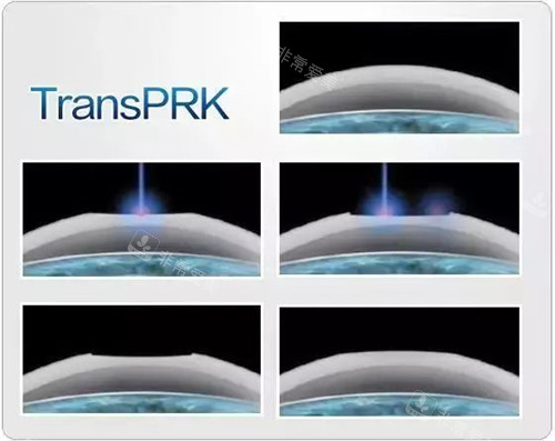 TPRK近视手术示意图