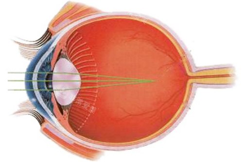 近视光线示意图