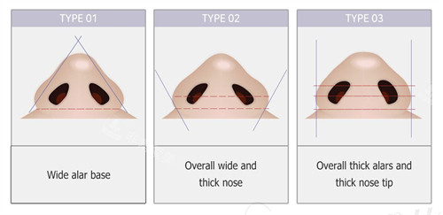 鼻翼缩小的流程图