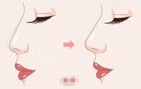 鼻梁鼻尖抬高前后对比图