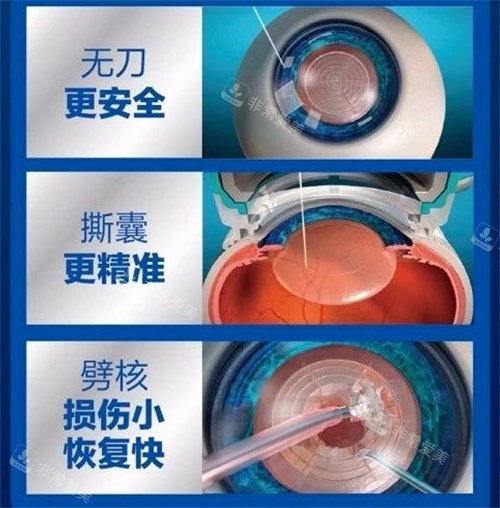 飞秒激光治疗白内障手术图