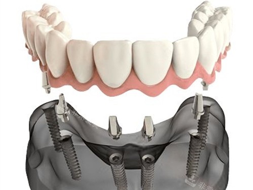 半口种植牙联排牙冠安装示意图