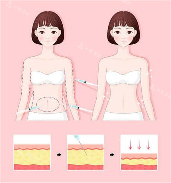 腰腹吸脂对比 腰腹吸脂对比