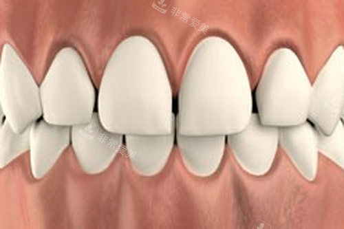 牙齿稀疏示意图