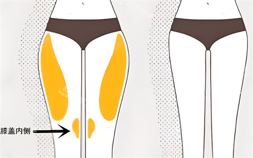 腿部吸脂前后对比