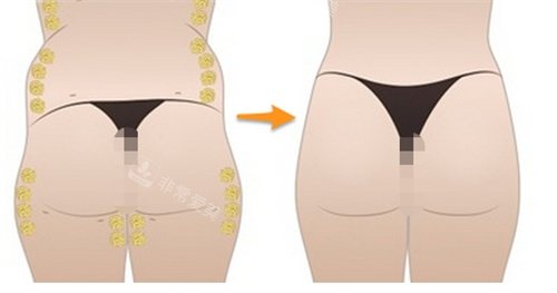 臀部脂肪填充过程展示图