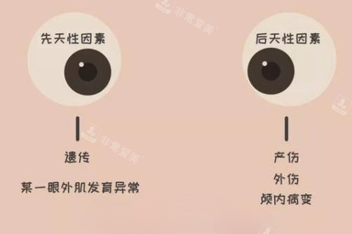 眼睛斜视产生原因卡通图片