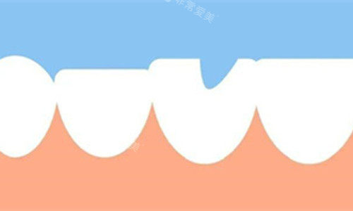 牙齿缺失一块展示图