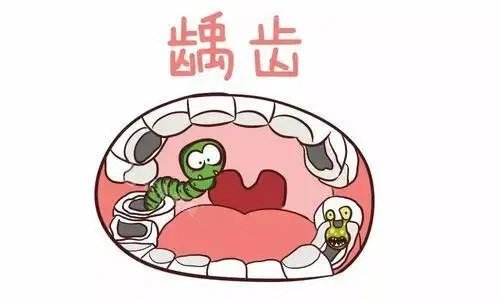 牙齿龋齿示意图