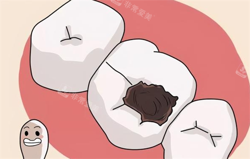 龋齿图片：重度龋齿动画展示