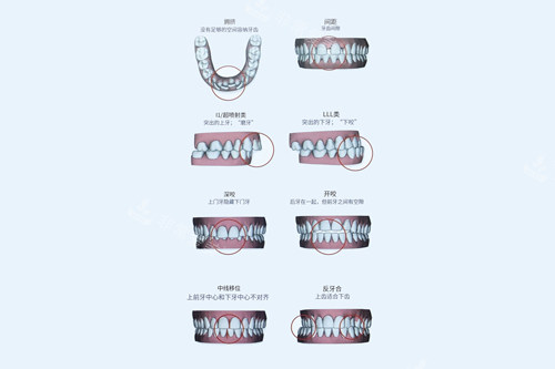 牙齿不齐的不同类型表现图